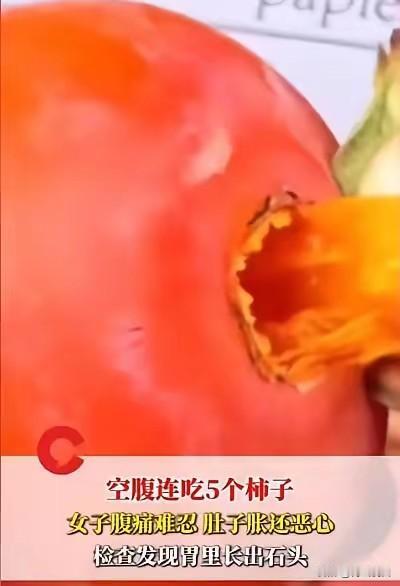 好家伙！张阿姨这5个柿子下肚，直接给胃里“种”了颗石头！这事儿听起来吓人，但医生
