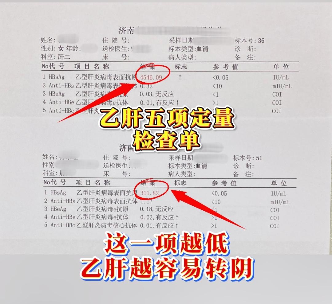 乙肝五项检查单，表面抗原越低，转阴的概率越大！尤其是低于1500的人群...