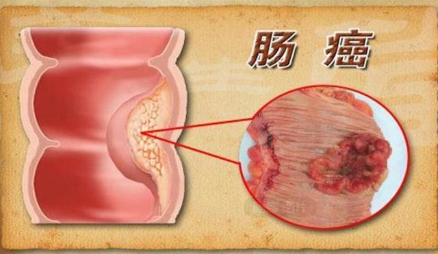 浙大解剖100名肠癌死者, 研究发现: 易患肠癌的人, 有几大恶习