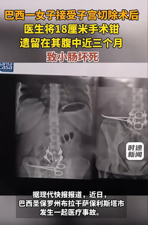 “太疏忽了！”7月30日报道，巴西，一女子在做子宫切除手术时，医生没注意，把约1