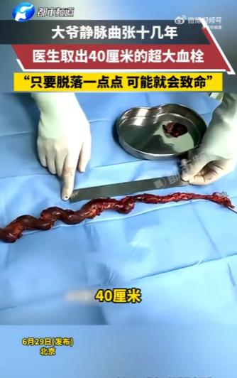 太吓人了！北京，一老人的腿被“小蚯蚓”缠了十几年，本以为是老毛病，谁知医生竟从血
