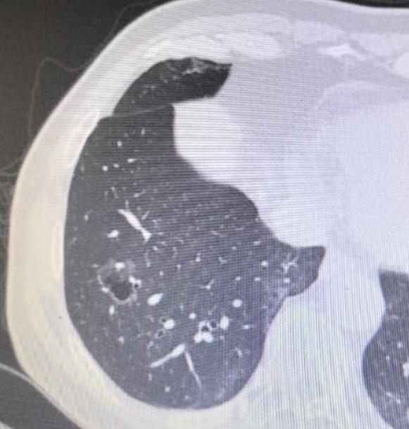 我的同行，一位75岁的医务工作者，6年前体检偶然查出的肺病灶，之后便一直处于