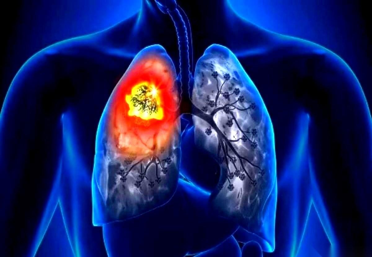 那个把一个家庭主妇送进肺癌病房的，根本不是烟，是她引以为傲的厨艺。对，你没听错