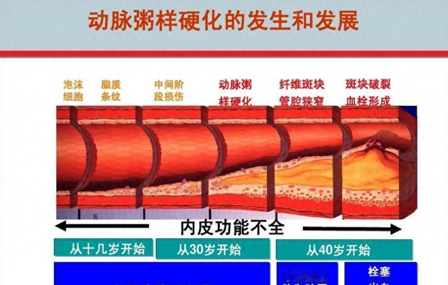 2025年，国家卫生健康委发布新指南。早干预，药物加生活方式，一些人狭窄可从75