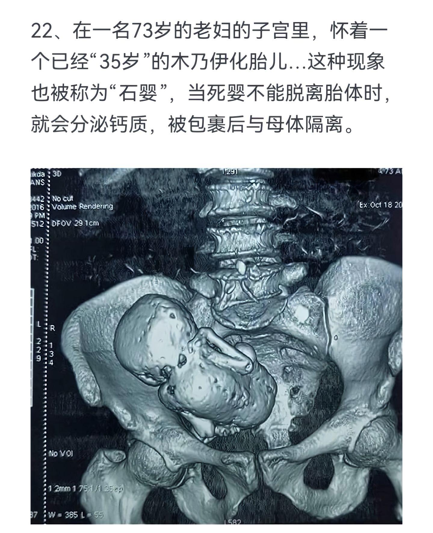 在一名73岁的老妇的子宫里，怀着一个已经