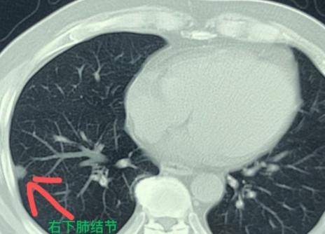 68岁男性患者,因为感冒后咳嗽一直没好,就来医院做了个胸部CT。结果偶然发现,右