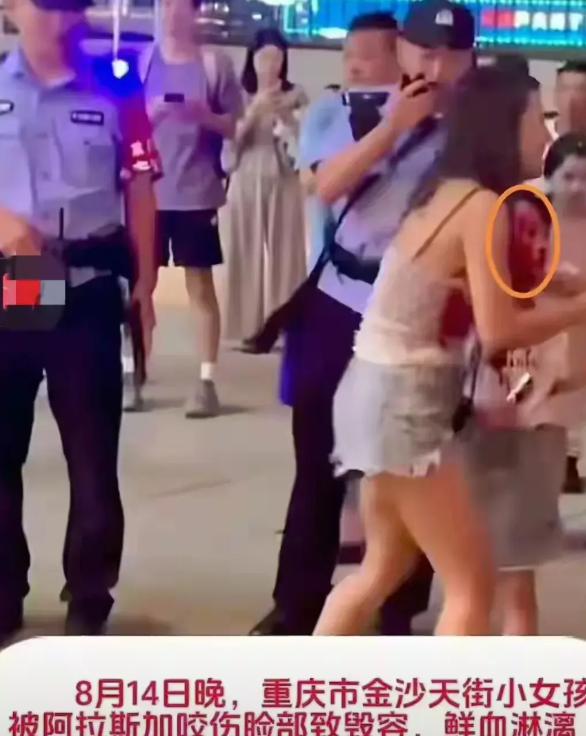 百斤大狗撕咬女孩后续：治疗费约30万，狗主人和女孩家长见面。重庆沙坪坝三峡广