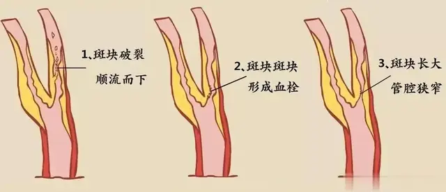 动脉硬化斑块到底能不能被逆转, 哪种药物有这种作用? 医生讲清楚