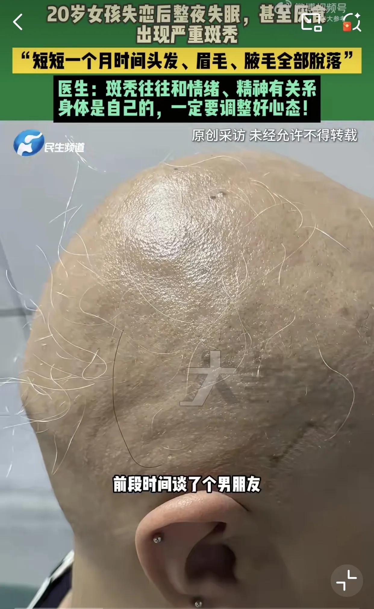 河南郑州，20岁女孩恋爱被男友“捡了”，遭遇断崖式分手。情绪崩溃，严重斑秃，头