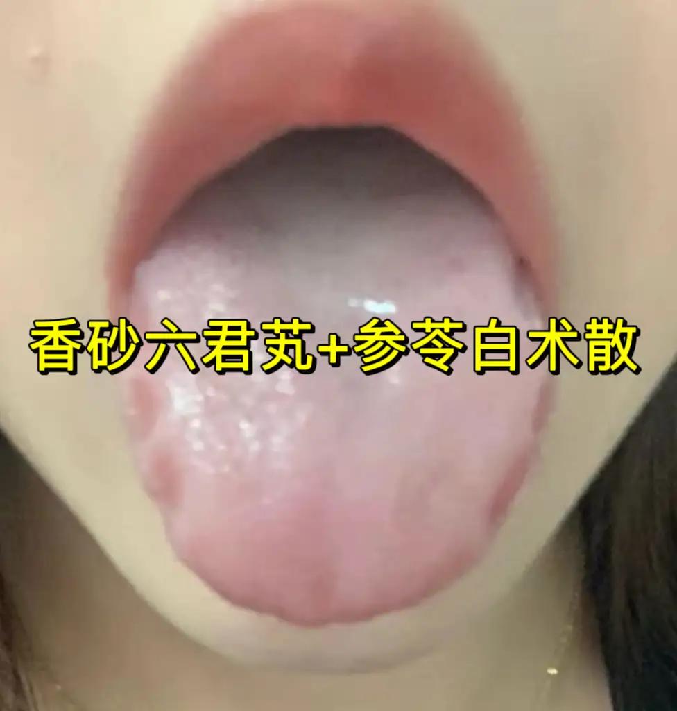 香砂六君丸搭对1味药：脾胃强了、痰湿消、气也顺1.香砂六君丸+平胃丸