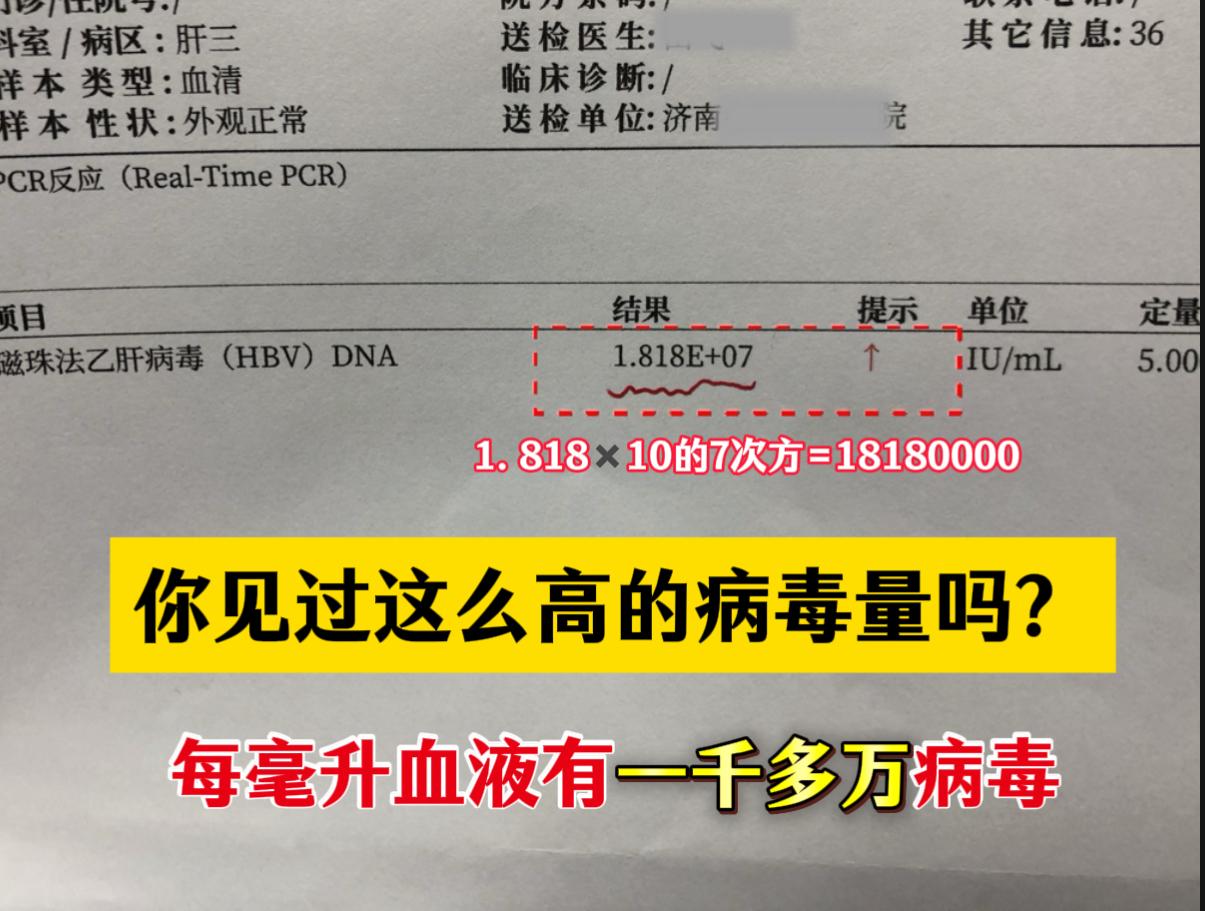 38岁的一位男士来就诊，乙肝大三阳，病毒量7次方，每毫升血液中有一千多...