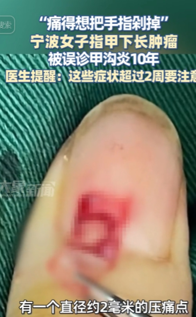 “太离谱了！”浙江宁波，一女子右手中指的指甲持续疼痛10年！每次洗个手都隐隐刺痛
