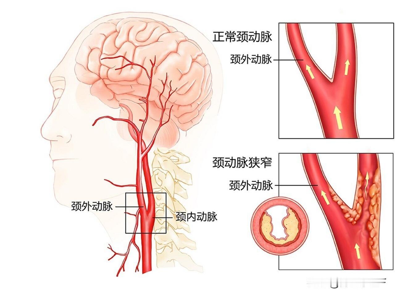 颈动脉斑块如何形成?之前刷到体检报告里一堆人查出颈动脉斑块，好多人才三十多岁就