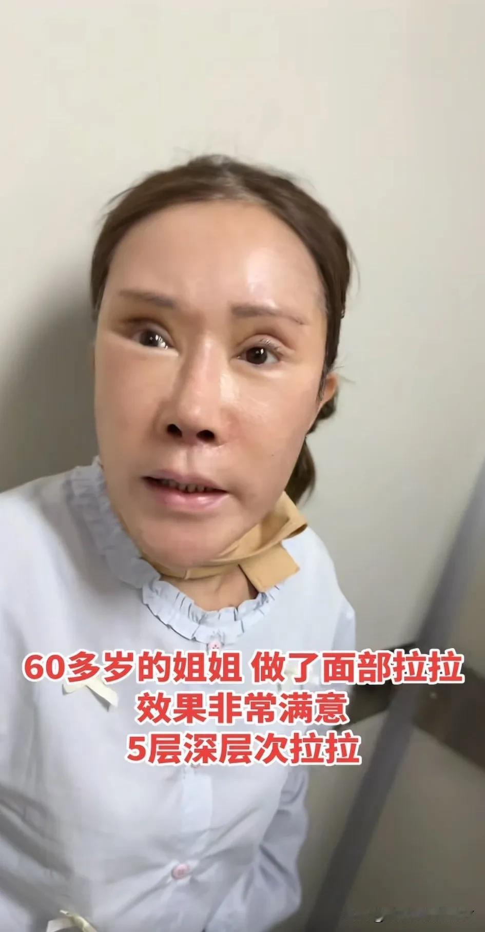 今天看了一个视频，60岁的大姐做的医美。说实话，刚看的时候吓一大跳，这算医疗事
