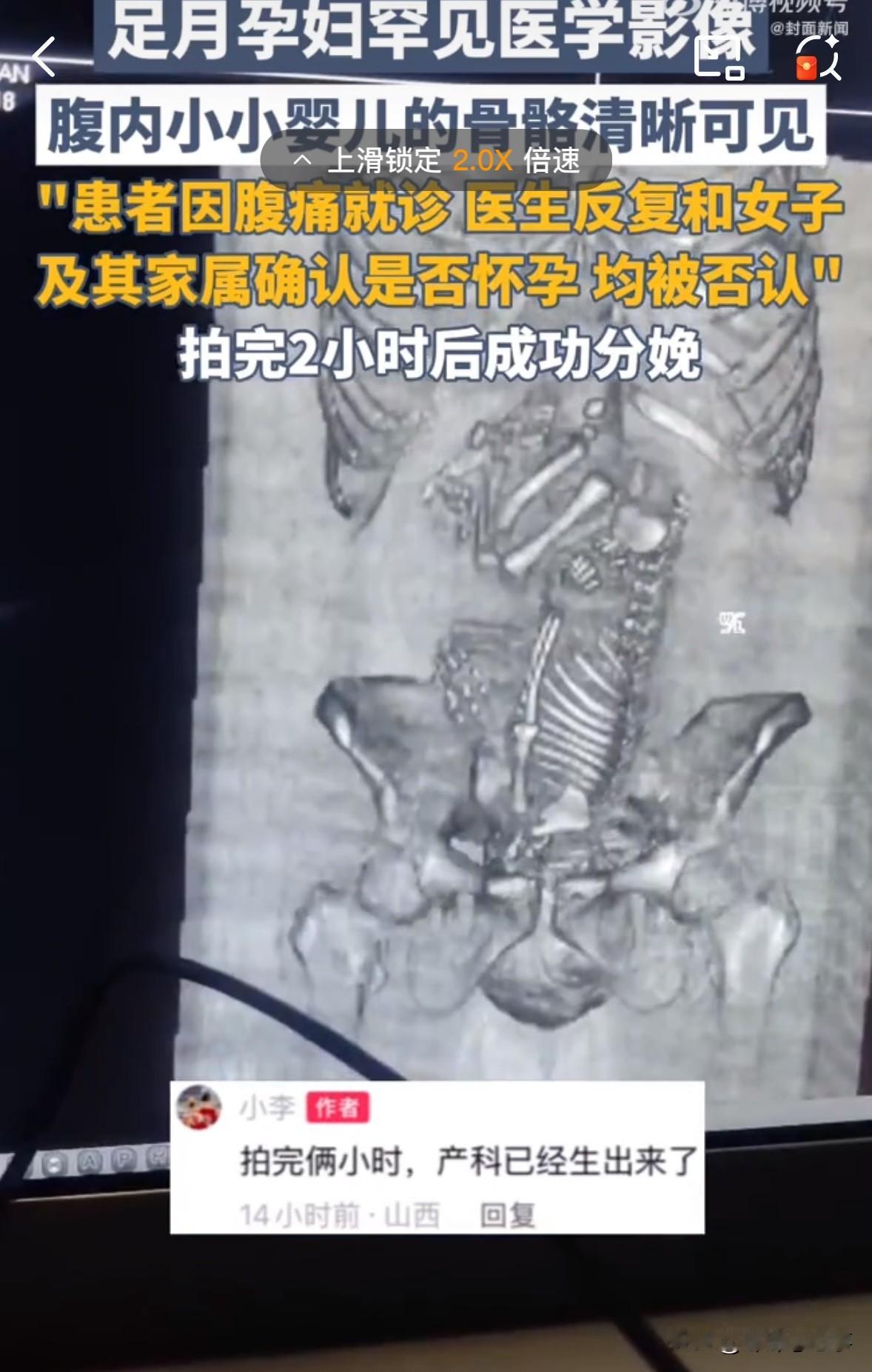 天崩开局！孩子一出生就不知道孩子父亲是谁19岁姑娘肚子疼去医院，俩小时就生了