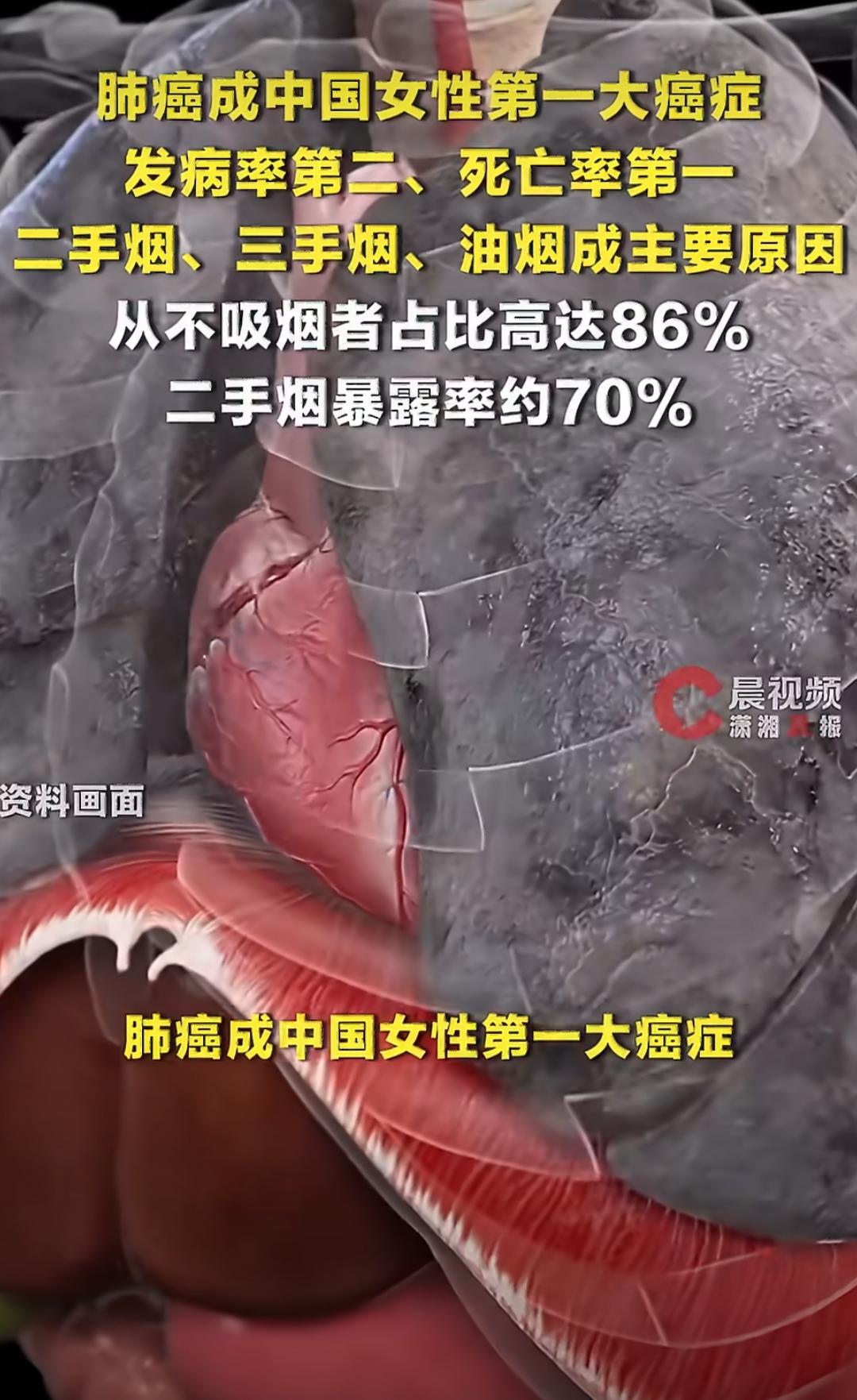 最近，肺癌成了中国女性的第一大癌症，这事儿挺让人意外的。以前一提起肺癌，大家总觉