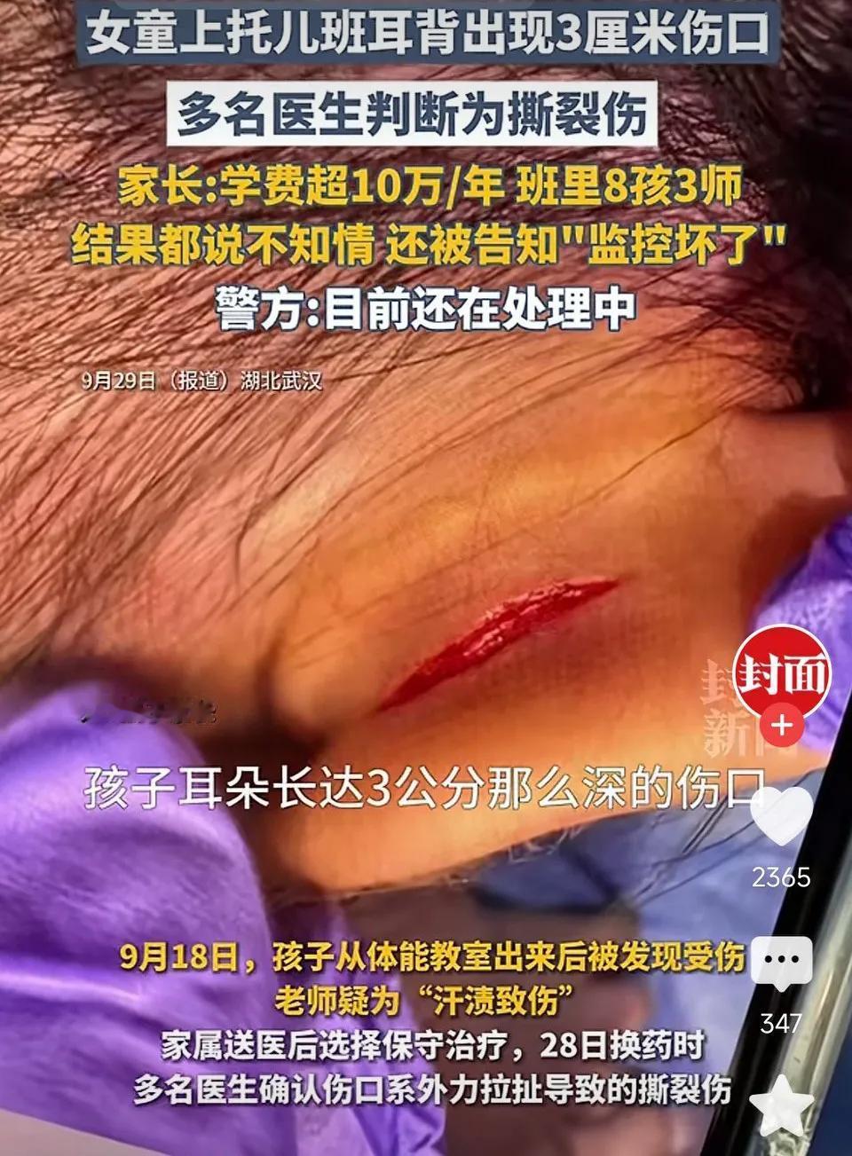女童上托儿班耳背出现3厘米伤口！多名医生判断为撕裂伤，家长:“班里8孩3师，结果