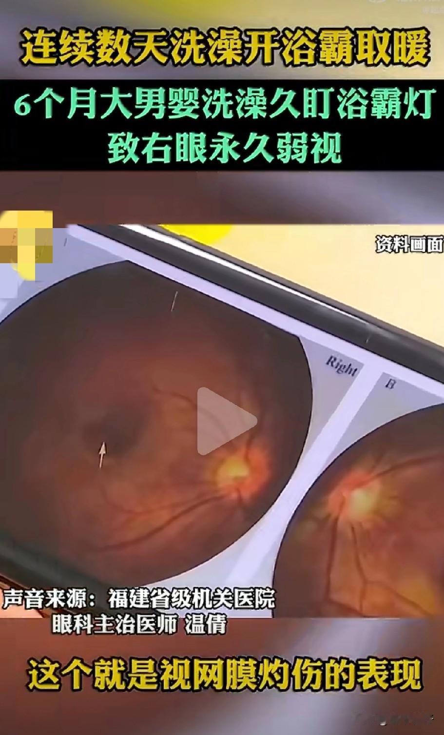 近日福建一名宝妈为避免六个月大的儿子洗澡着凉，连续多日开着浴霸给孩子洗澡。婴儿因