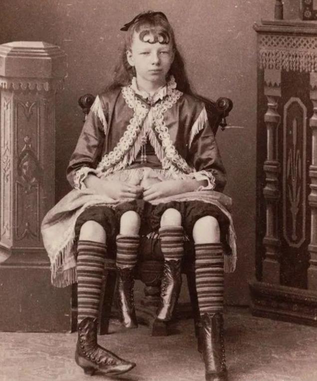 上世纪60年代，美国一个长着四条腿和两个生殖器官的女孩，被父亲高价卖给马戏团，女