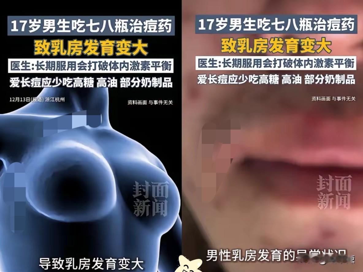 “离谱！”浙江杭州，一男生青春期长痘，为祛痘自行买药吃，结果乳房竟异常发育！