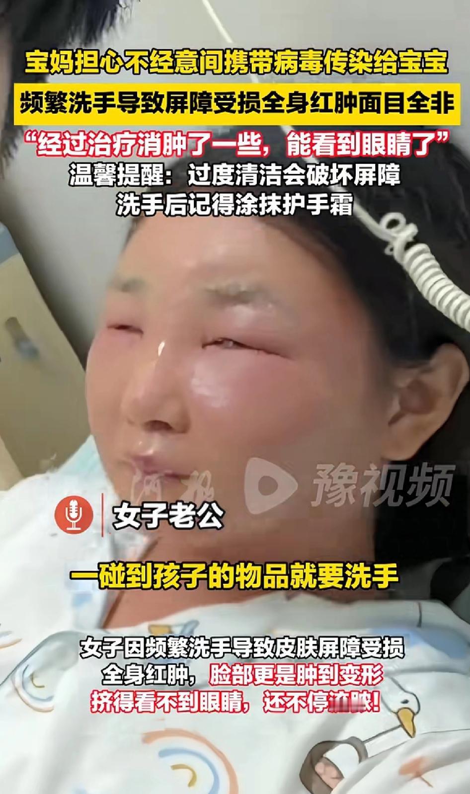 宝妈担心不经意间携带病毒传染给宝宝，频繁洗手导致屏障受损全身红肿、面目全非，这画