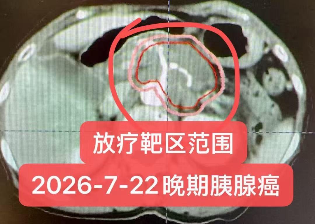 一例晚期胰腺癌的综合治疗。患者，女性，79岁。临床分期：晚期胰腺癌（c...