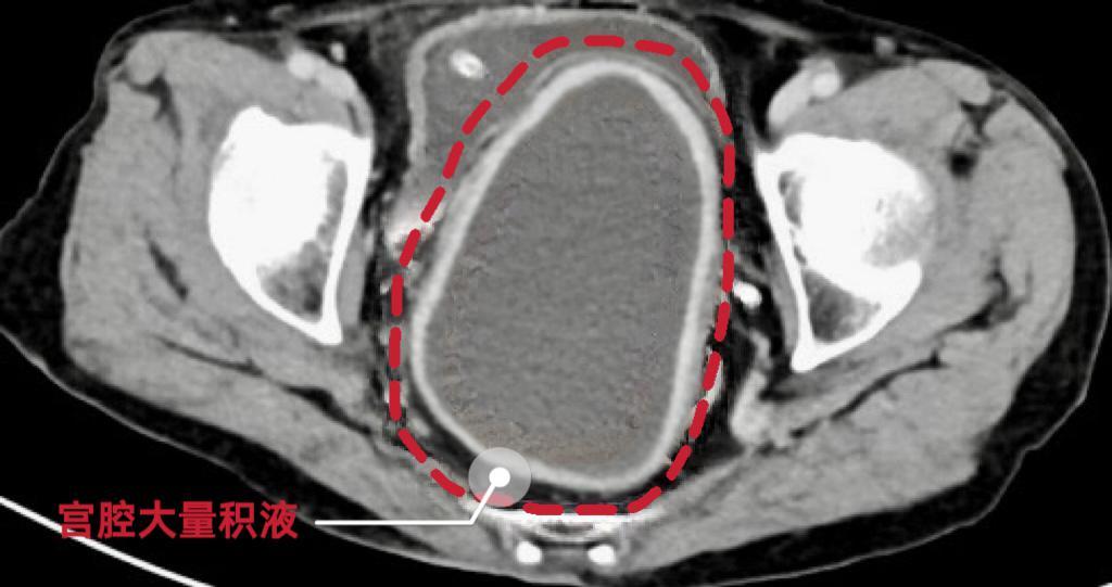 绝经女性警惕！八旬老太腹痛入院，医生从她宫腔抽出约250ml腥臭味黄绿色脓液
