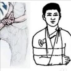 偏瘫后肩膀“掉下来”？小心肩关节半脱位！ 很多偏瘫患者在病发之后会出现肩膀“