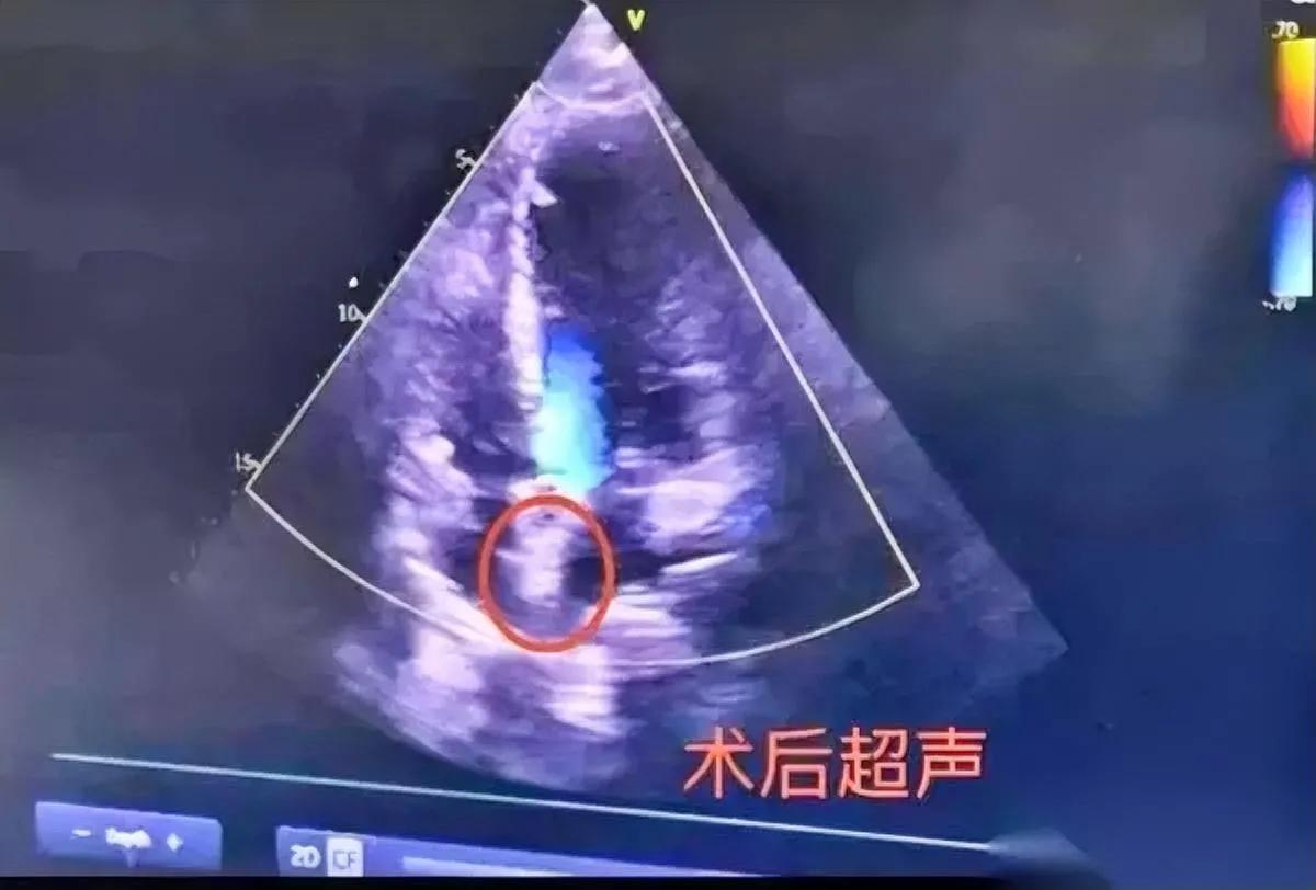 头痛20年有多煎熬?40岁李姐快被折磨疯了竟是心脏“心眼”在作怪?李