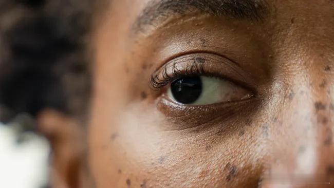 逆转“懒惰眼”：注射麻醉剂或可有效治疗！12月4日，发表在NewScientis