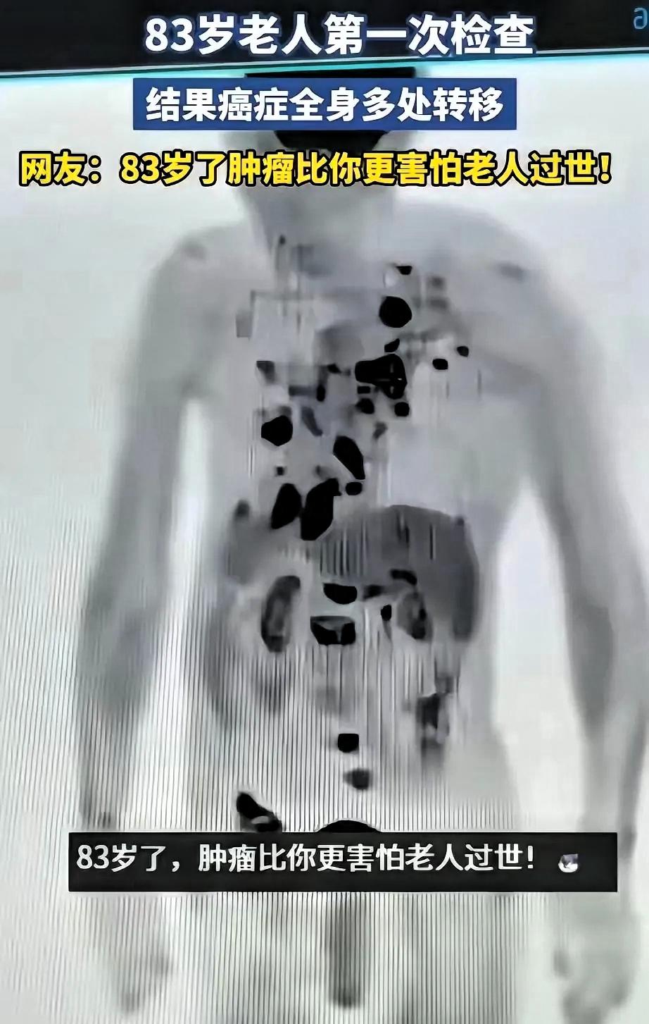 一位83岁的老人生活开开心心，健健康康，在儿女的提议下做了体检，检查后发现体内多