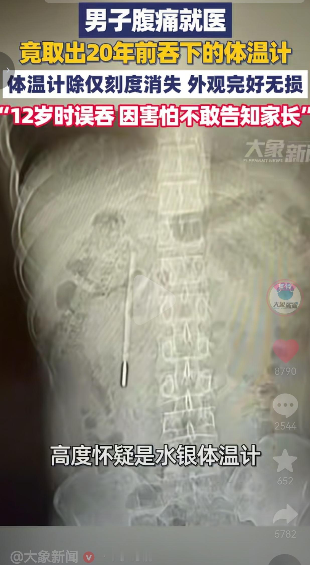 太吓人了！32岁的王先生因为肚子痛去趟医院，医生一查CT，好家伙——他的十二指肠