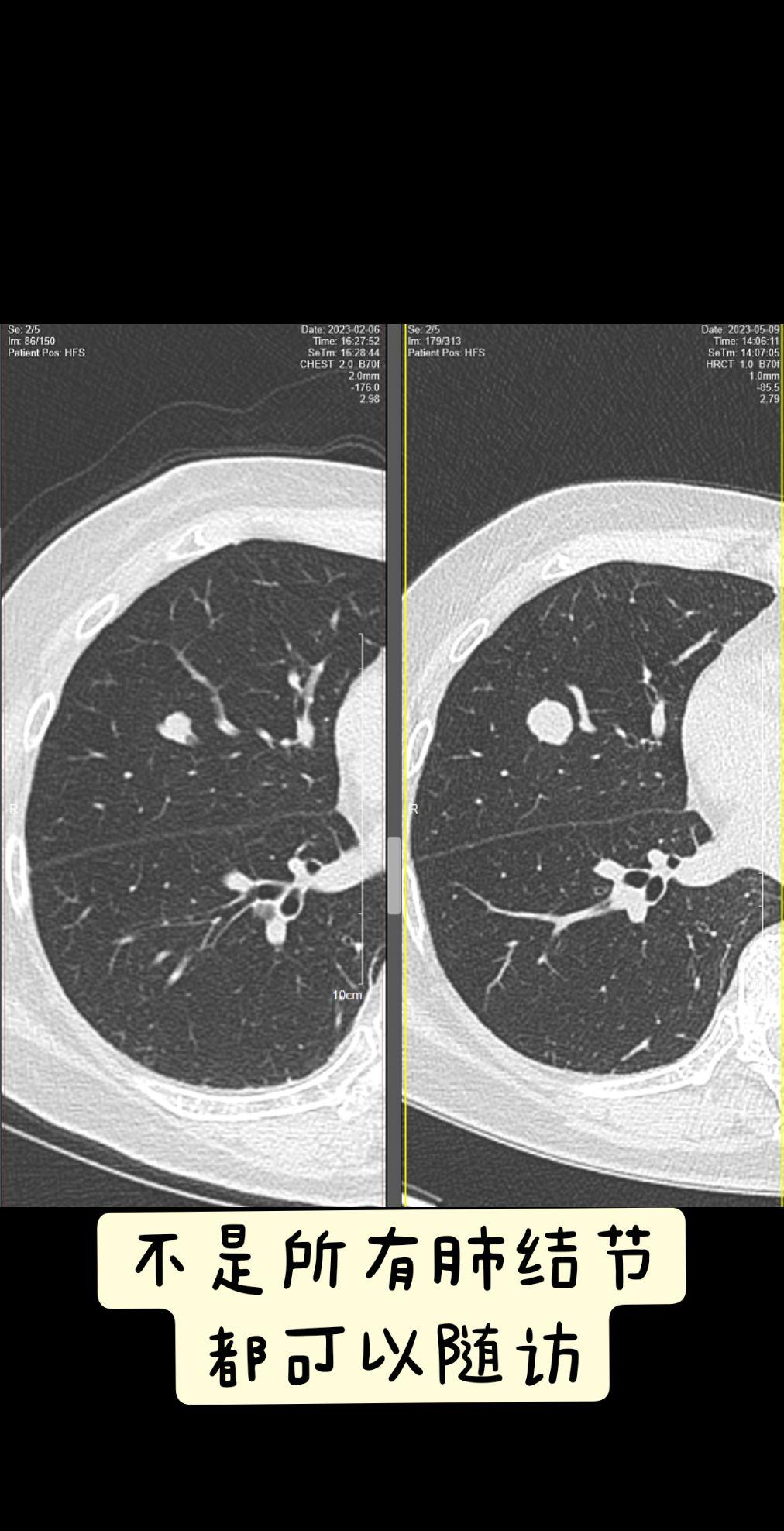 这是一例右肺中叶实性肺结节患者，三个月肺结节直径增长一倍，不是所有肺结...