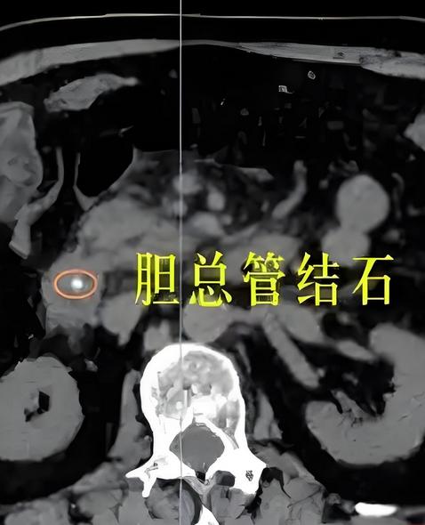 胆结石，随胆汁化解这张方子源于经典古籍《金匮要略》中调治“胆腑瘀滞”的思