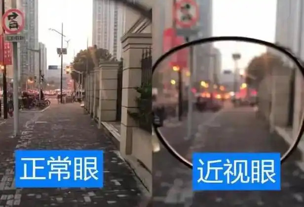 眼睛度数降了100度个例吧，近视不是不可逆吗？不过现在手机电脑不离身，不涨就等