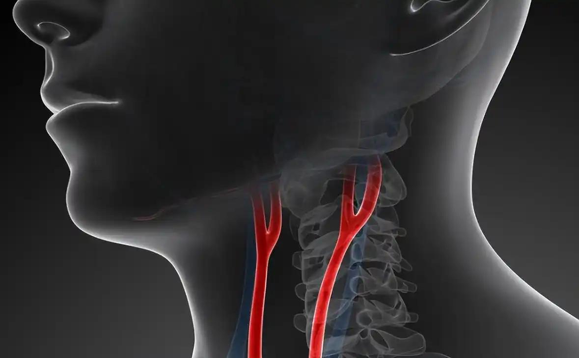 48岁女子查出颈动脉斑块，三年后脑梗瘫痪，医生惋惜：无知害人 48岁正是上有