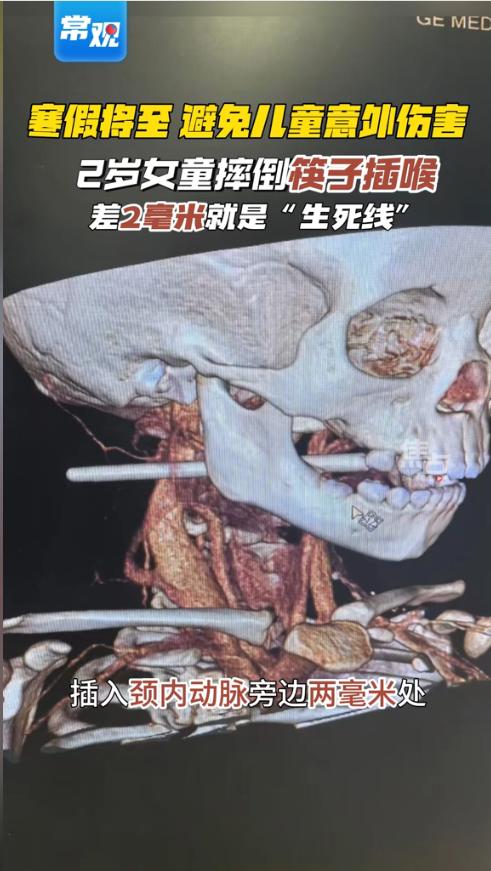 “悲剧还是发生了！”近日，江苏常州，一2岁女童吃饭时起身跑跳玩耍，结果脚下一滑重