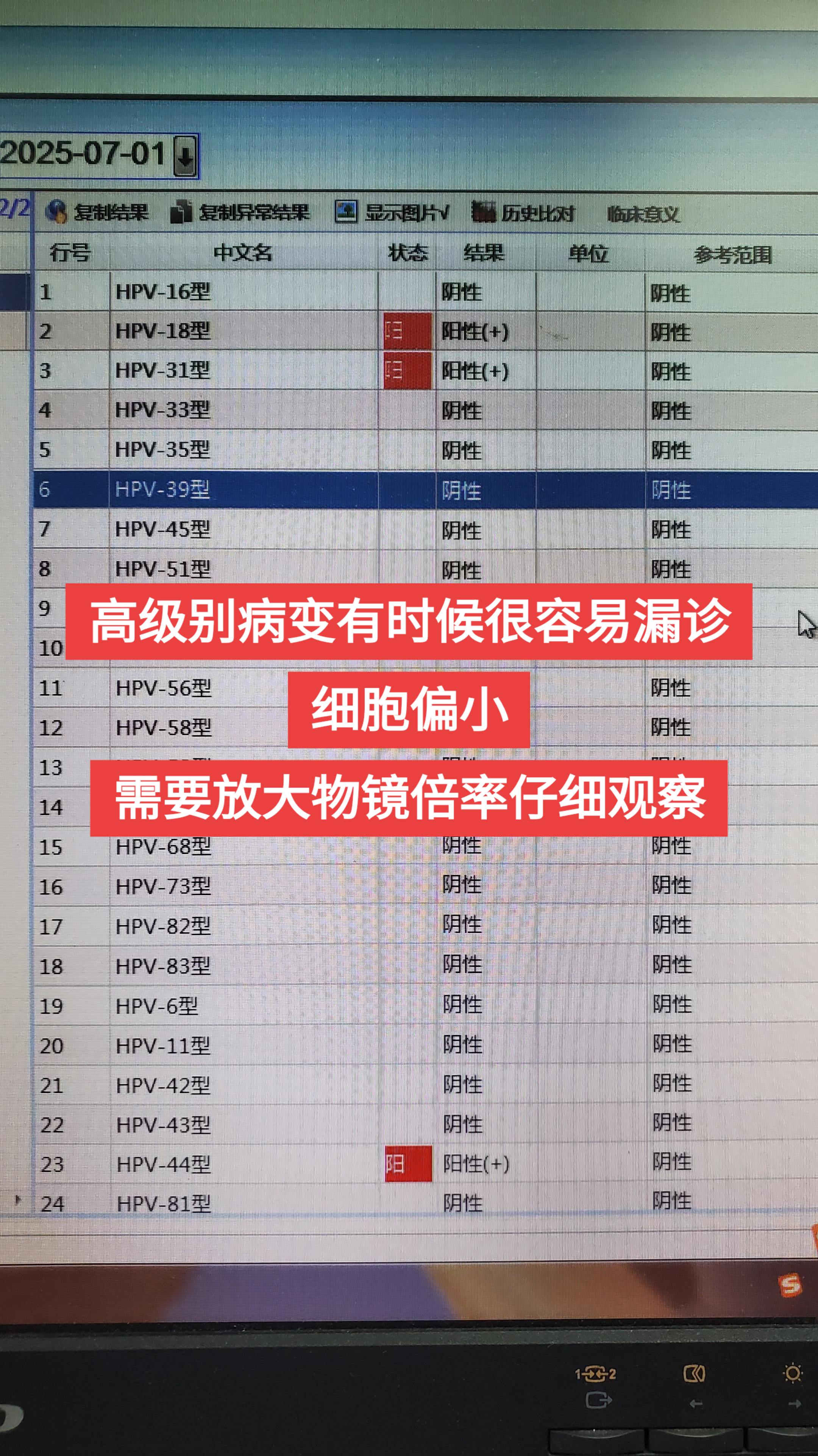 高级别上皮内瘤变 hpv感染