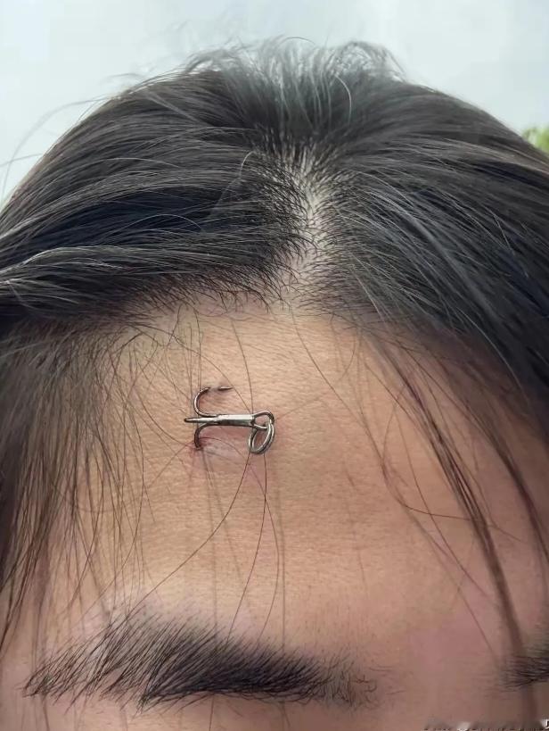 头回出门钓鱼的大哥，甩竿没把控好力度，鱼钩直接扎旁边看热闹小姑娘头上。小姑娘当场