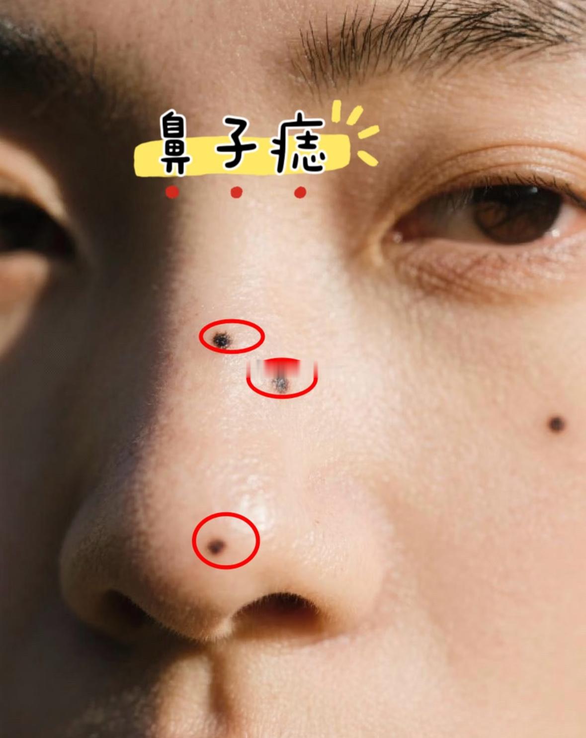 鼻子为财帛宫，鼻上、鼻翼周遭的痣，关联财运与心性🍃1.鼻头正中长痣：正财丰厚