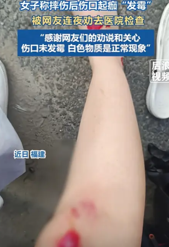 彻底解释不清了！福建，女子不慎摔伤，伤口起痂竟然开始发白，她发到网上求助，结果，