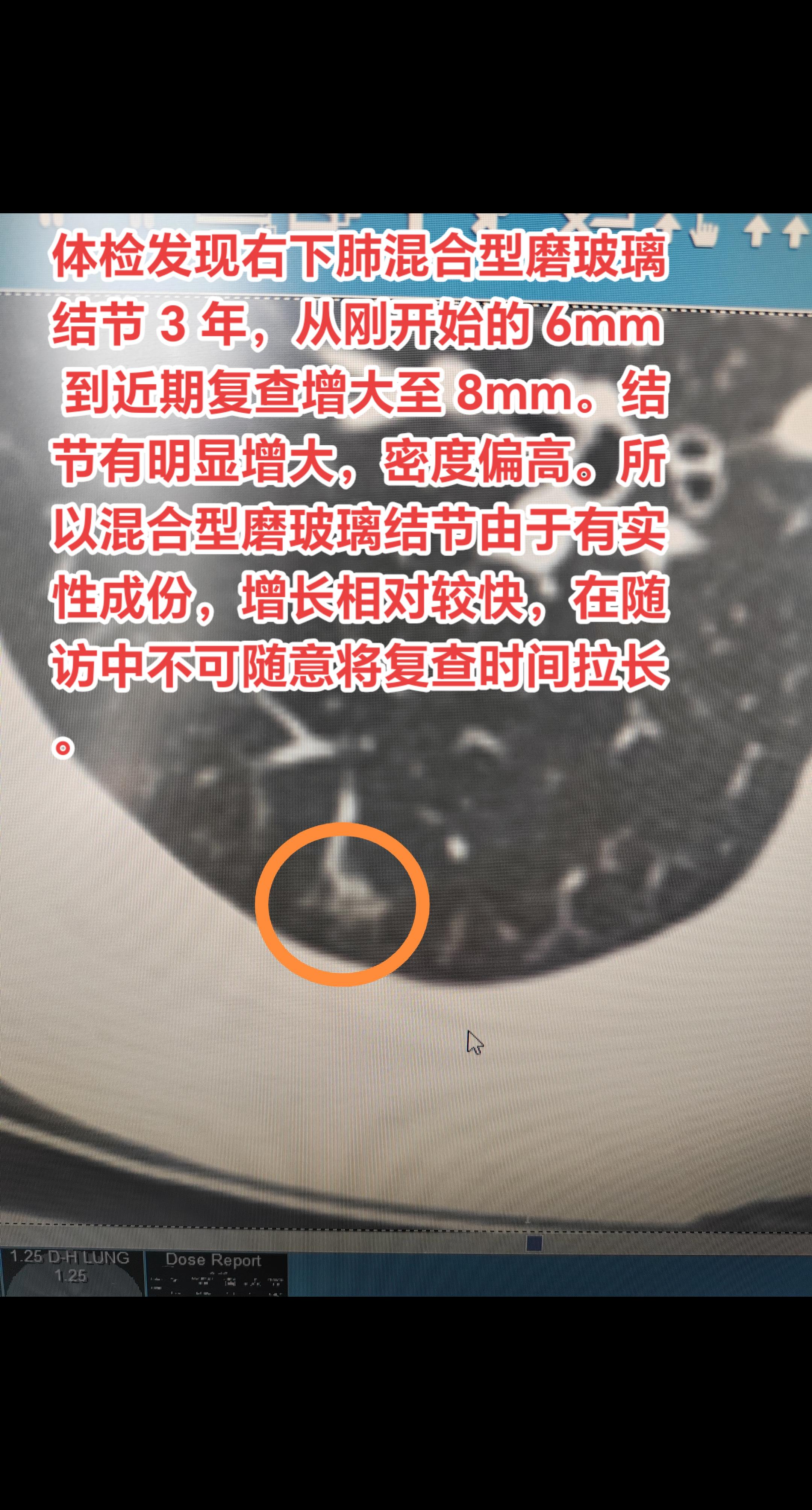 混合型磨玻璃结节。体检发现右下肺混合型磨玻璃结节 3 年，从刚开始的 ...