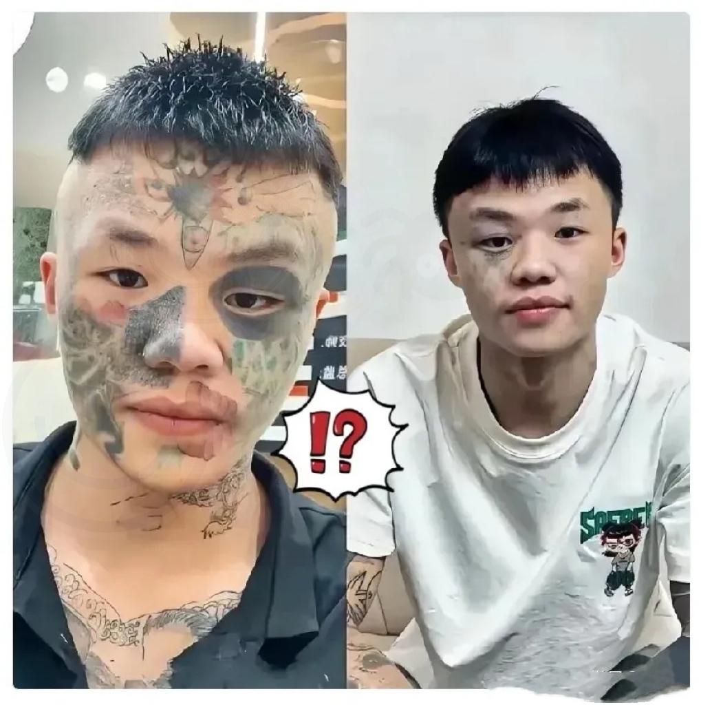 广东，纹面男孩夏朝勇为了洗掉年少时的纹身，已经做了三次激光清洗，再洗两次就能完全