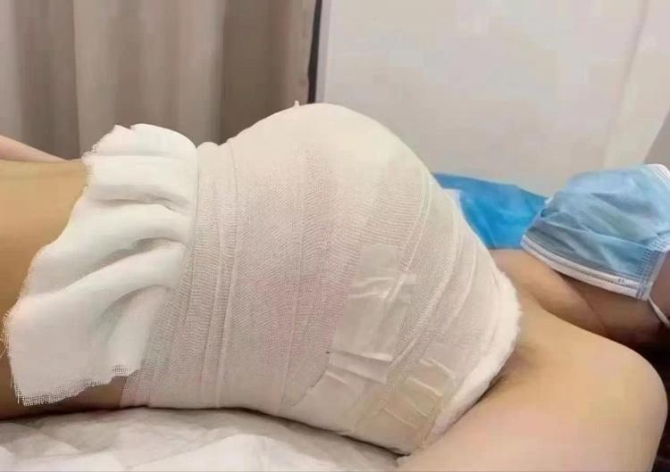 真的太揪心也太离谱了！昆明一位张女士，刚做完隆胸手术仅一周，就查出自己怀上了双胞