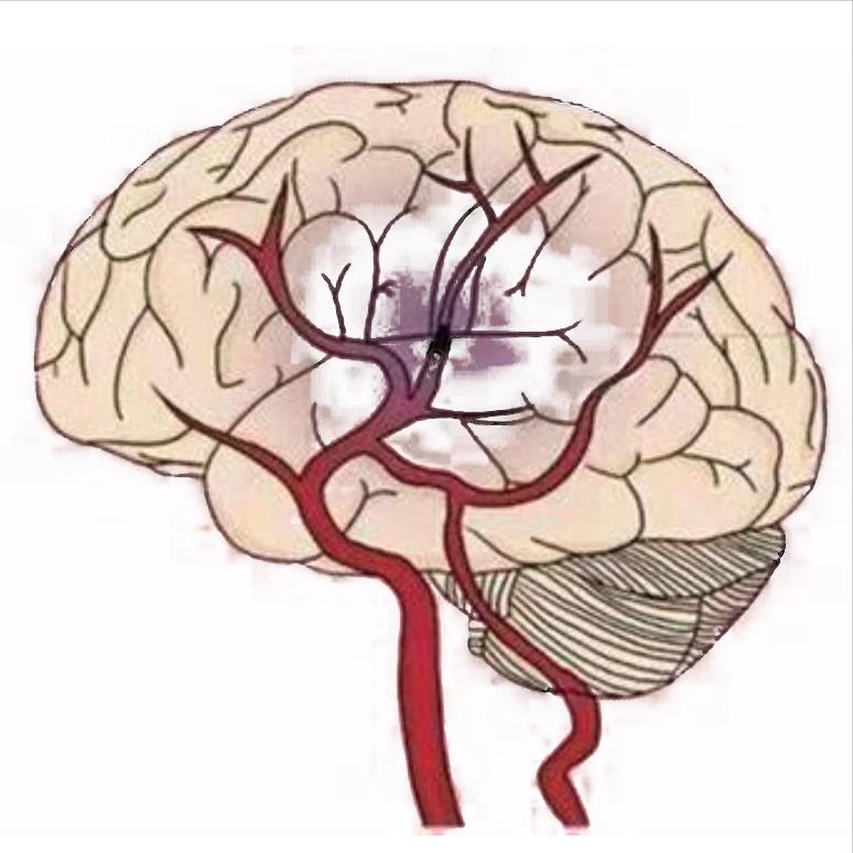 脑梗发生前，身体会给这4次“保命”机会！多数人都错过了很多人以为脑梗是老年人才