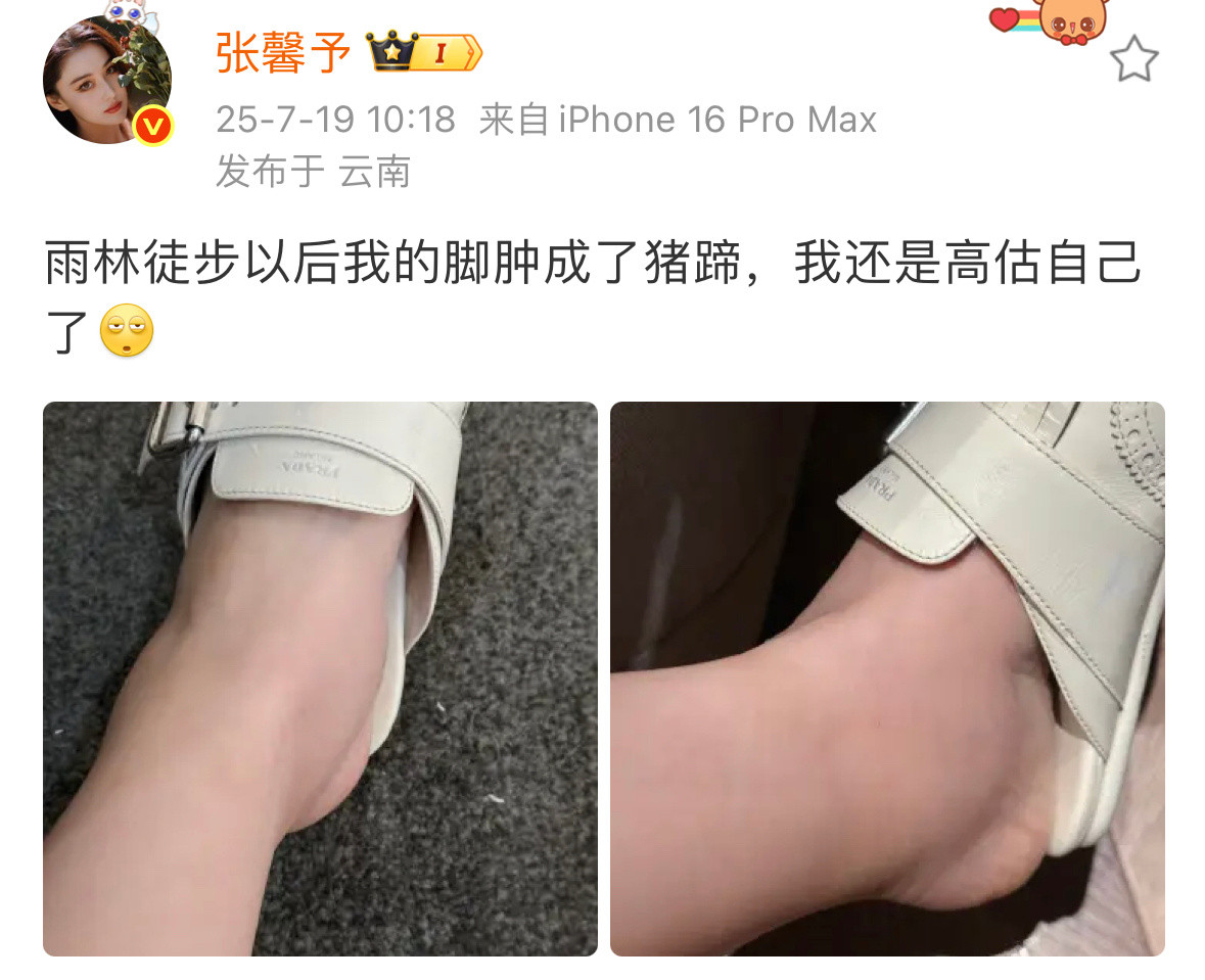 张馨予的脚肿成了猪蹄张馨予说还是高估自己了张馨予说还是高估自己了，雨林徒步后脚肿