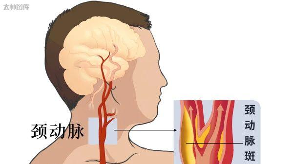 改善颈动脉斑块, 请记住这6点!