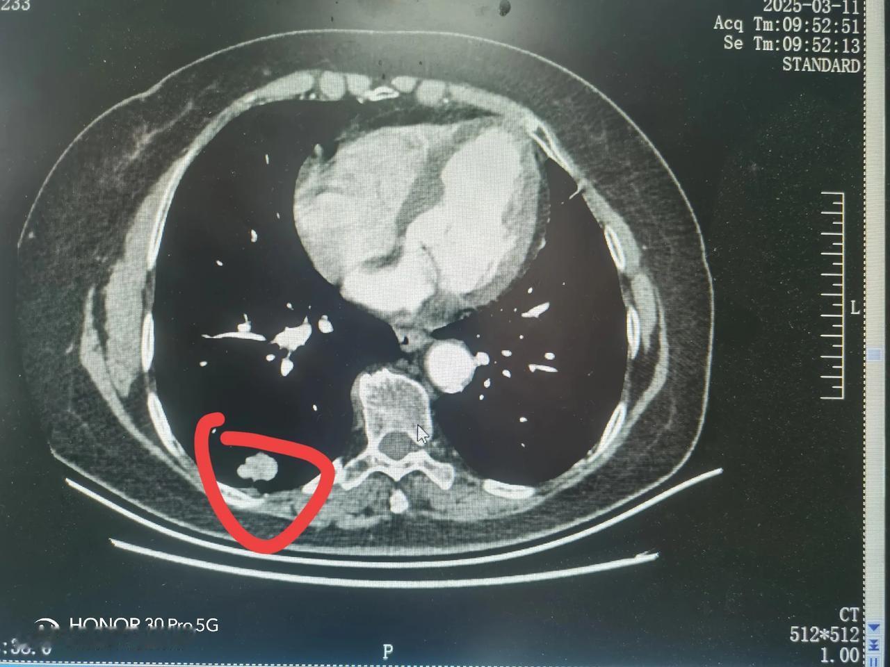 分享一病例，65岁女性，2025年2月在外院体检低剂量胸部CT发现右下肺一紧贴胸