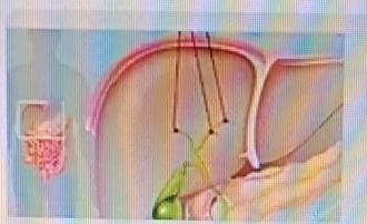 胆囊切除对身体的影响还挺多的。胆囊主要功能是储存和排放胆汁，切除后消化功能会受影