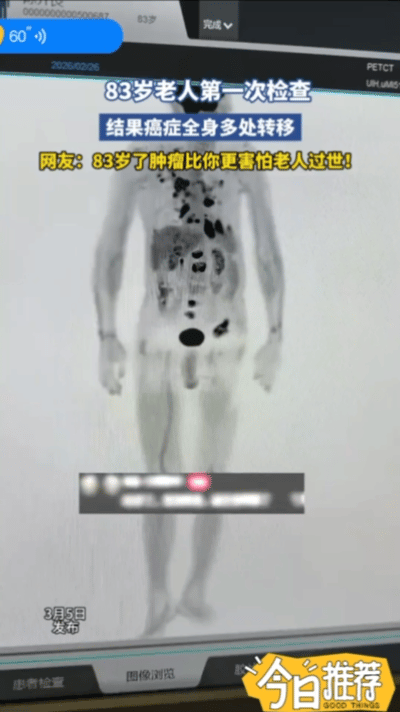 刷到这位安徽老人的视频，心里又酸又佩服。83岁的年纪，一辈子没做过全面体检，被儿
